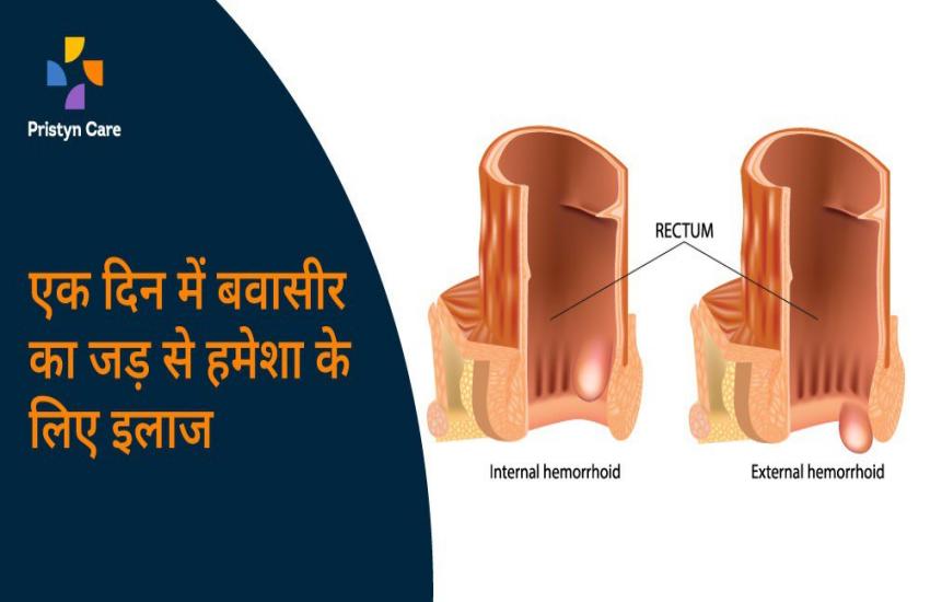 Pristyn Care में एक अपॉइंटमेंट और बवासीर से हमेशा के लिए छुटकारा