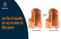Pristyn Care में एक अपॉइंटमेंट और बवासीर से हमेशा के लिए छुटकारा - image