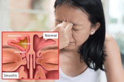 सिर दर्द, नाक बहना और चेहरे पर दर्द? साइनसाइटिस से मिलेगा आराम, जानें कैसे - image